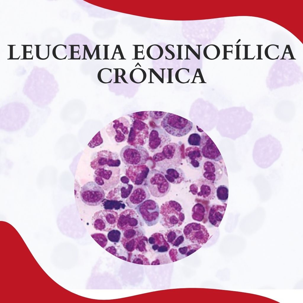 LEUCEMIA EOSINOFÍLICA CRÔNICA Atlas Em Hematologia