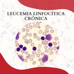 Leucemia Mielomonoc Tica Cr Nica Atlas Em Hematologia