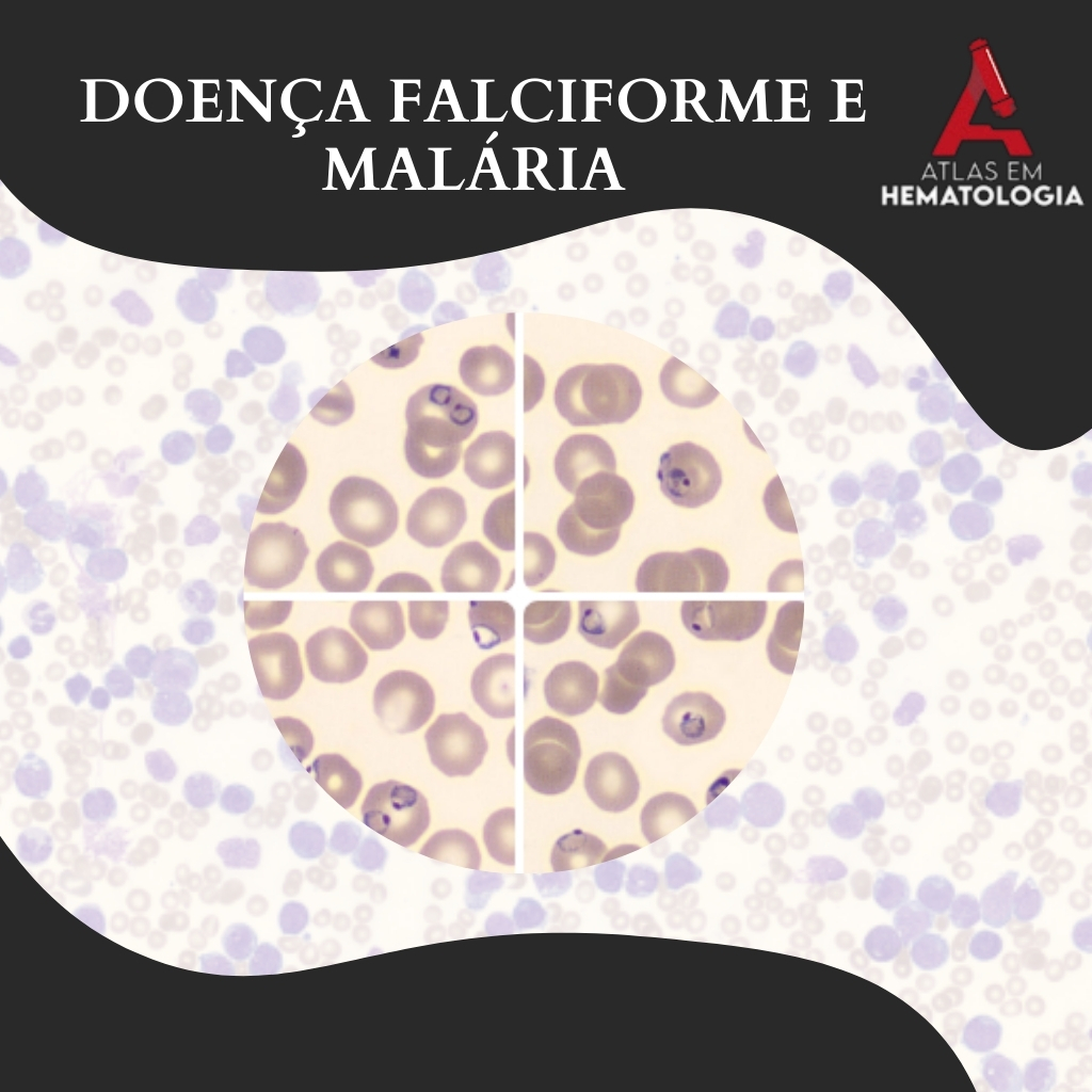 Doen A Falciforme E Mal Ria Atlas Em Hematologia