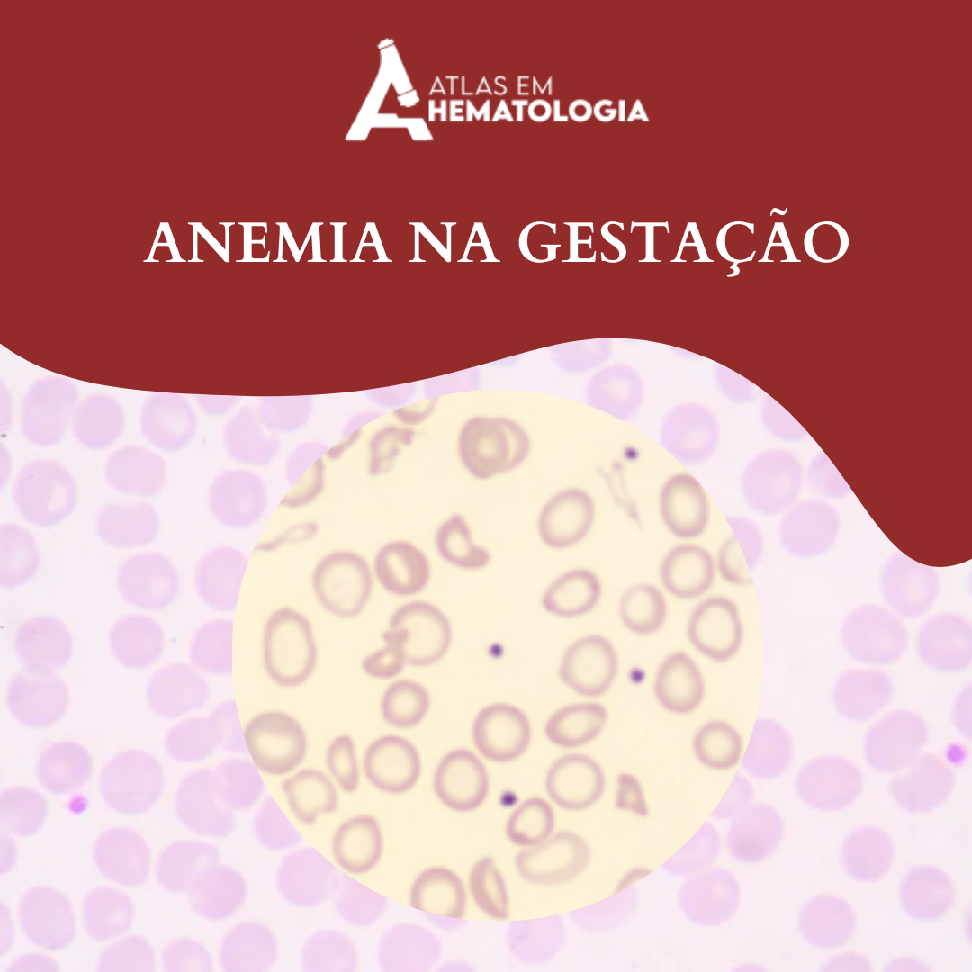 Anemia Durante A Gesta O Atlas Em Hematologia