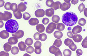 HemoClass - Hematologia e Medicina Diagnóstica - EU SEI QUE VOCÊ SABE Que existe granulação nessas células! Mas seria granulação tóxica ou grosseira? Preciso quantificar em % de neutrófilos, ou em %