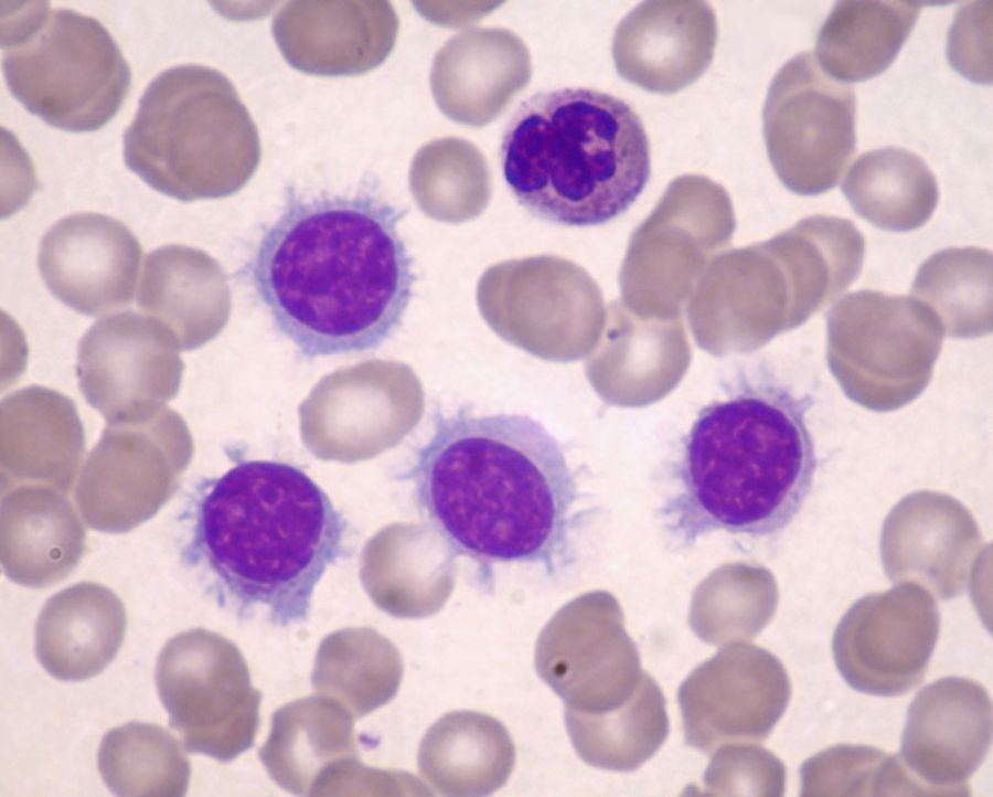 TRICOLEUCEMIA
