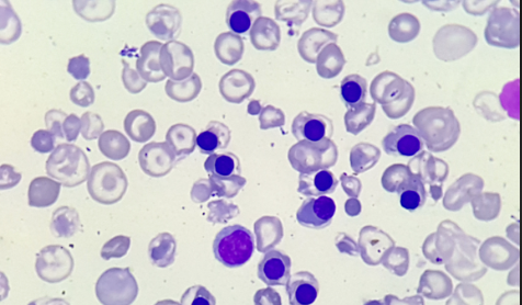 TALASSEMIA BETA
