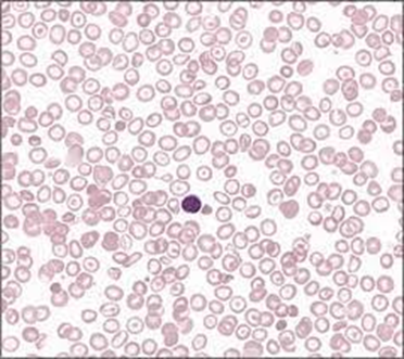 TALASSEMIA BETA  
