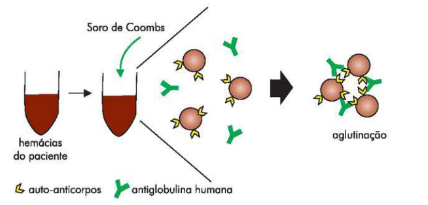 ANEMIA HEMOLÍTICA 