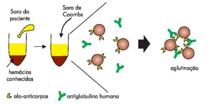 ANEMIA HEMOLÍTICA 