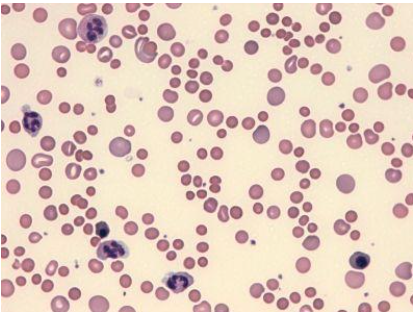 ANEMIA HEMOLÍTICA 