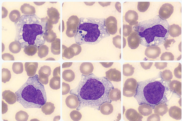 síndrome hemofagocítica