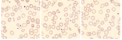 anemias