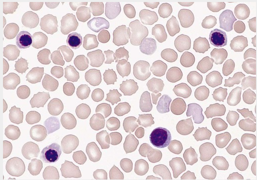 hematologia pediátrica