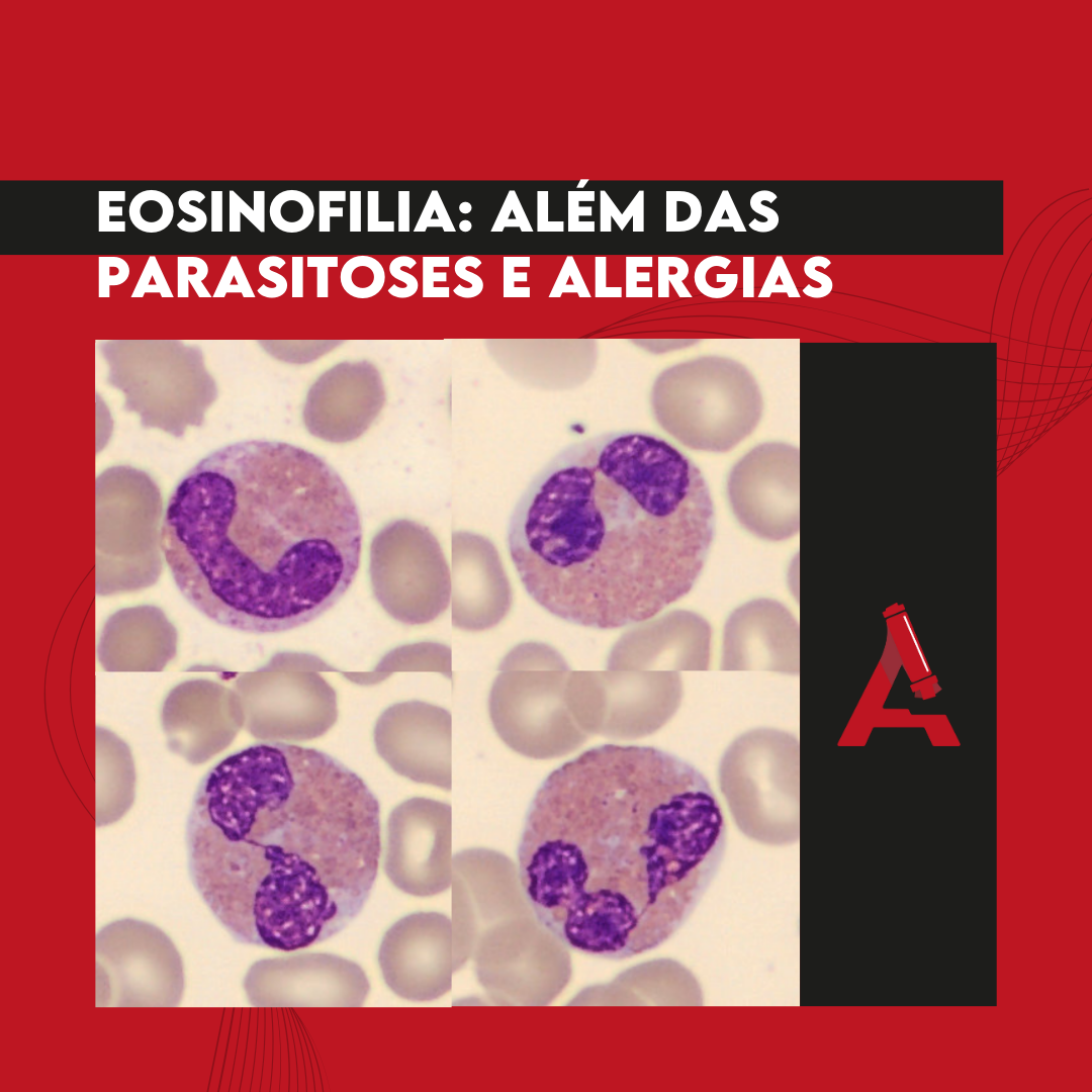 Eosinofilia: além das parasitoses e alergias - Blog - Atlas em Hematologia
