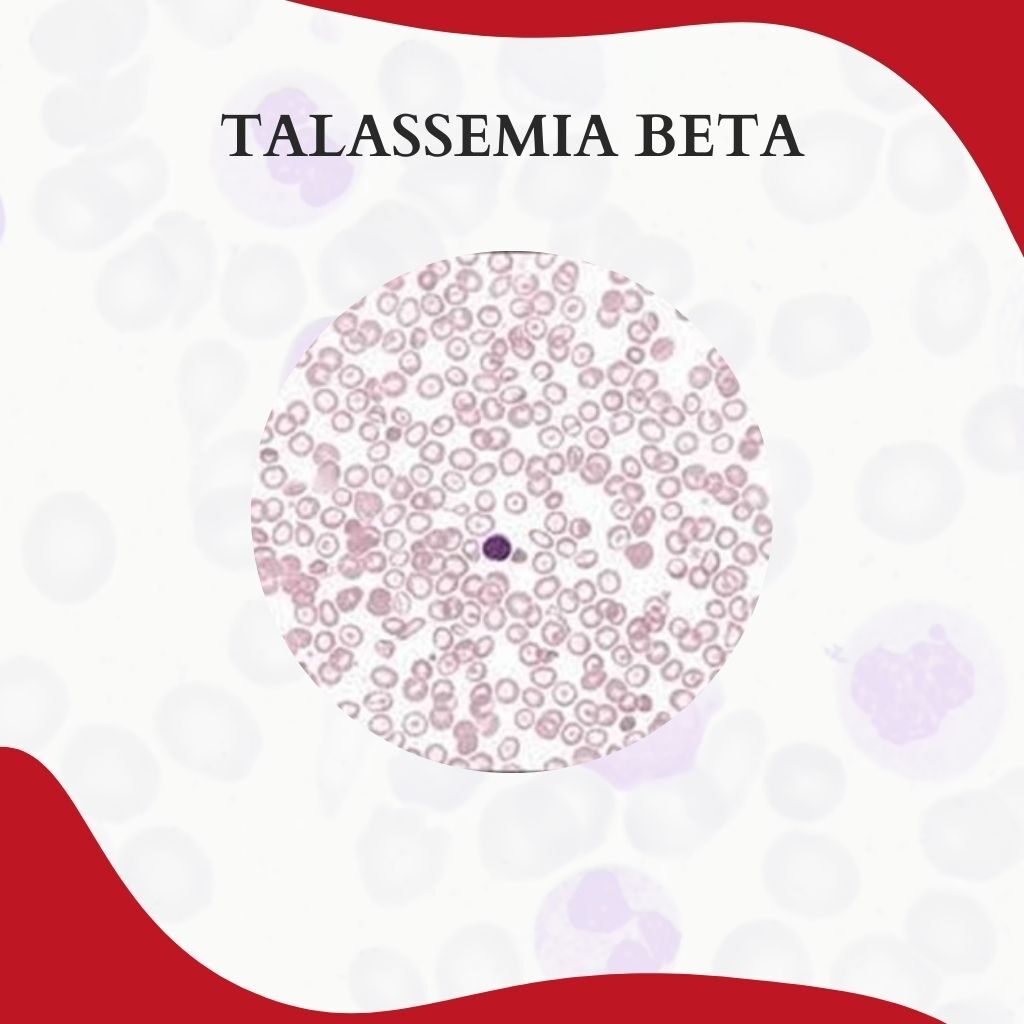 TALASSEMIA BETA: CARACTERÍSTICAS E DIAGNÓSTICO - Atlas Em Hematologia