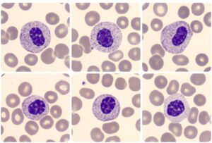 ANOMALIA DE PELGER-HUET - Atlas Em Hematologia