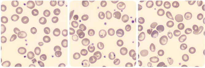 anemia sideroblástica