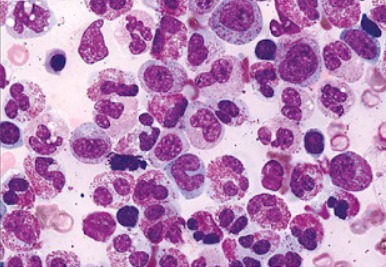 leucemia eosinofílica crônica