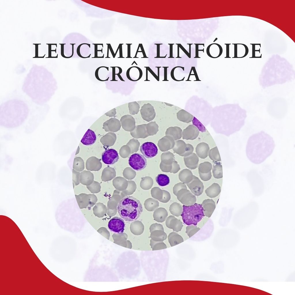 leucemia linfóide crônica