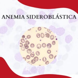 Anemia sideroblástica
