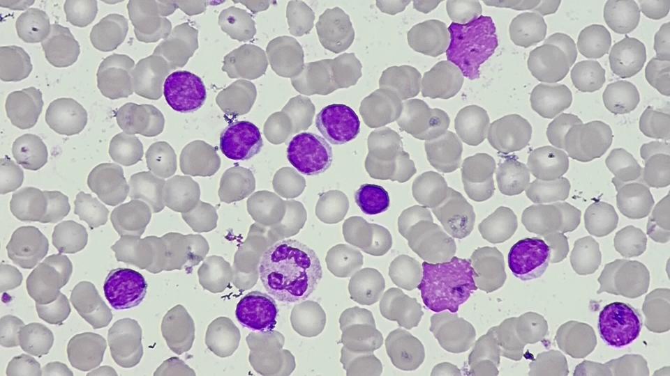 leucemia linfoide crônica