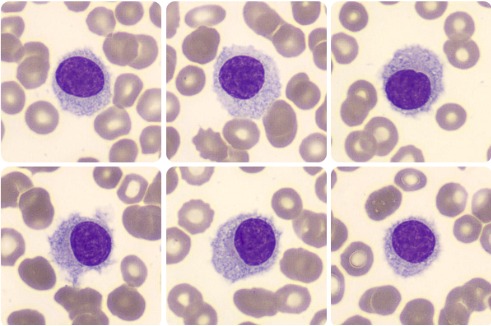 leucemia de células pilosas