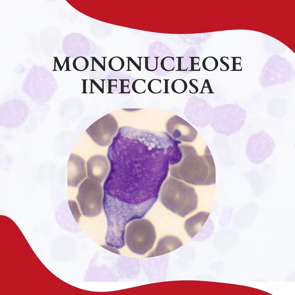 MONONUCLEOSE INFECCIOSA - Atlas Em Hematologia