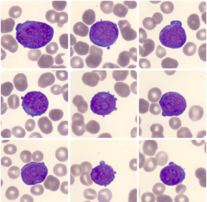 LINFOMA DE BURKITT - Atlas Em Hematologia