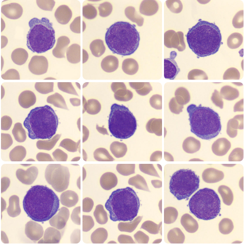 LEUCEMIA MEGACARIOCÍTICA AGUDA
