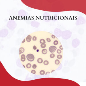 ANEMIAS POR DEFICIÊNCIA NUTRICIONAL