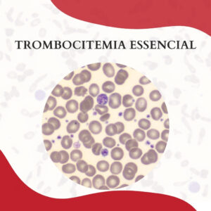 TROMBOCITEMIA ESSENCIAL
