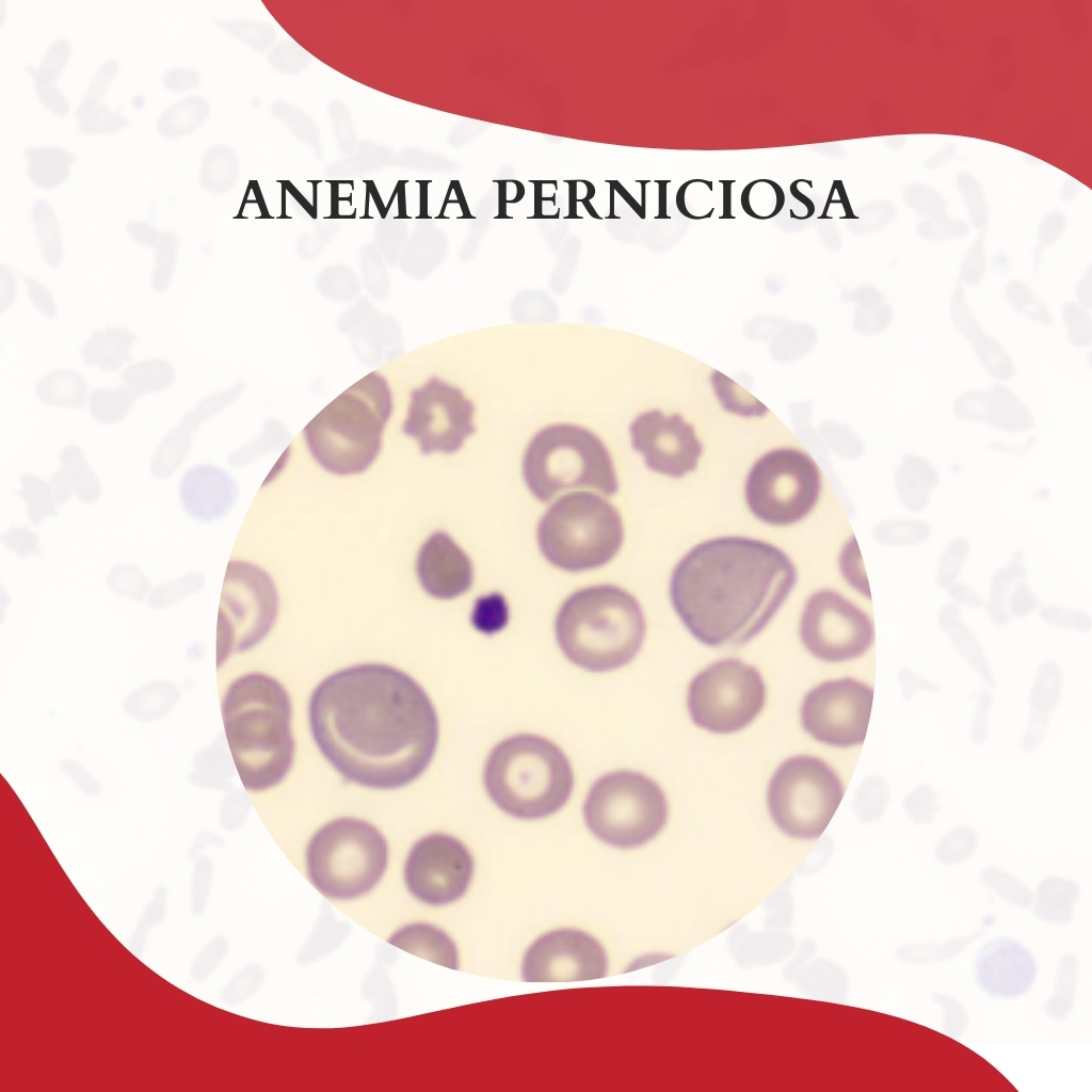 ANEMIA PERNICIOSA - Atlas Em Hematologia