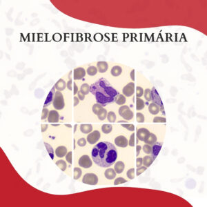 MIELOFIBROSE PRIMÁRIA