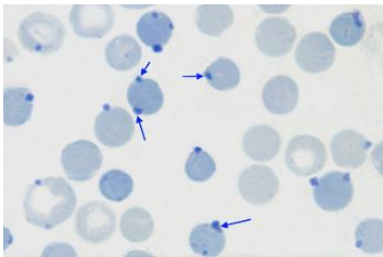 A anemia por deficiência de enzimática