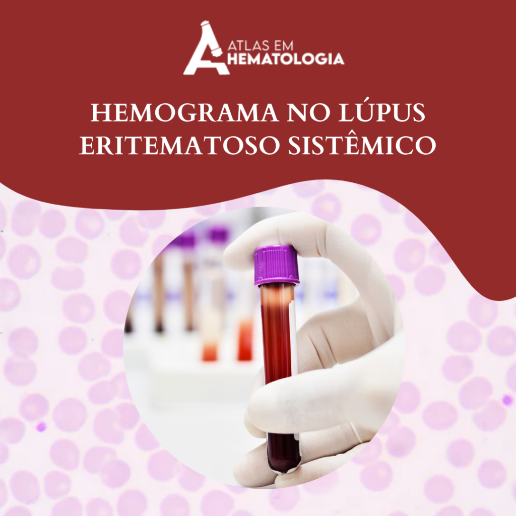 HEMOGRAMA NO LÚPUS ERITEMATOSO SISTÊMICO