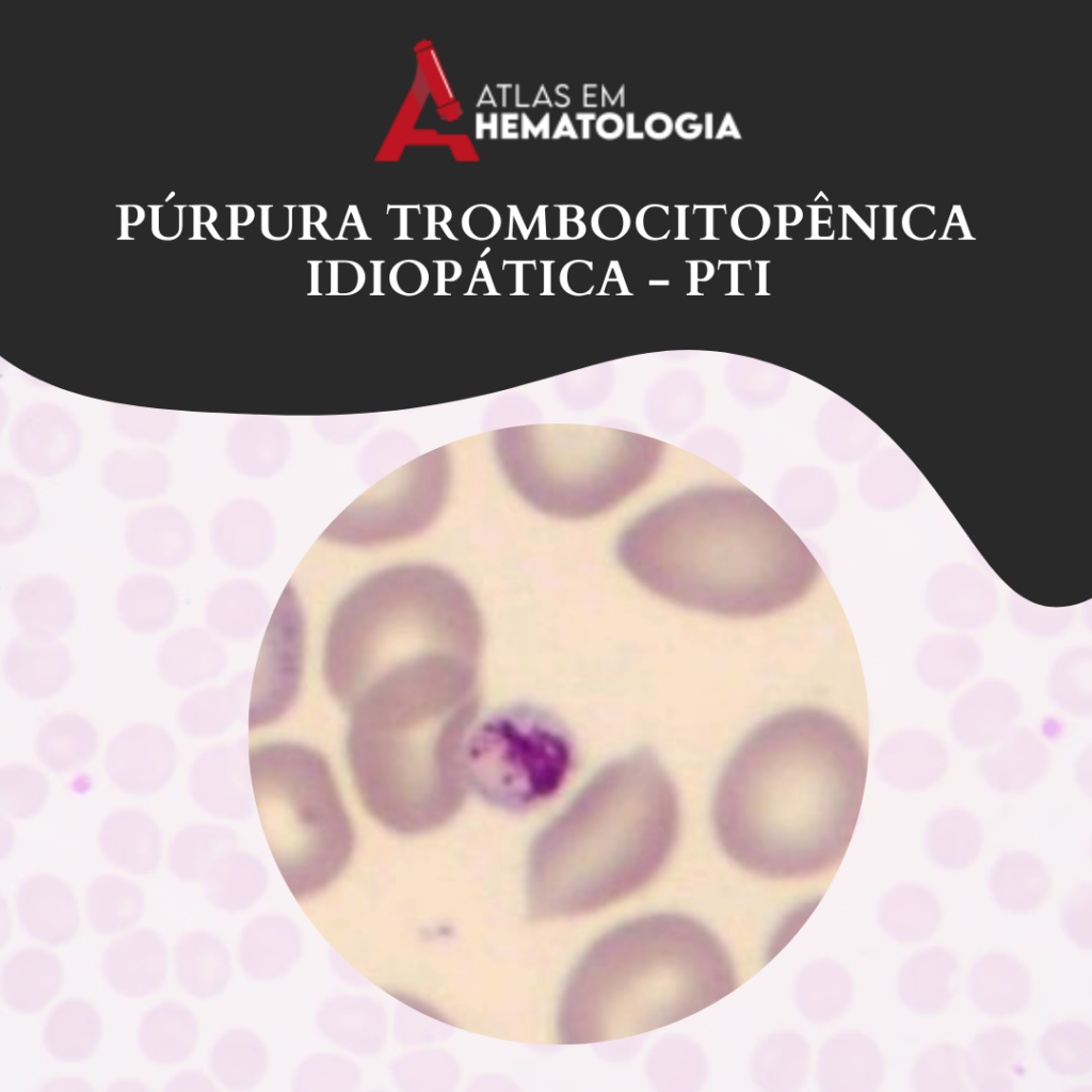 PÚRPURA TROMBOCITOPÊNICA IDIOPÁTICA – PTI