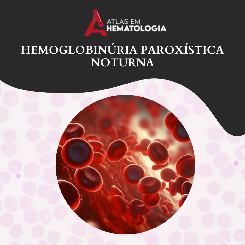 HEMOGLOBINÚRIA PAROXÍSTICA NOTURNA – HPN