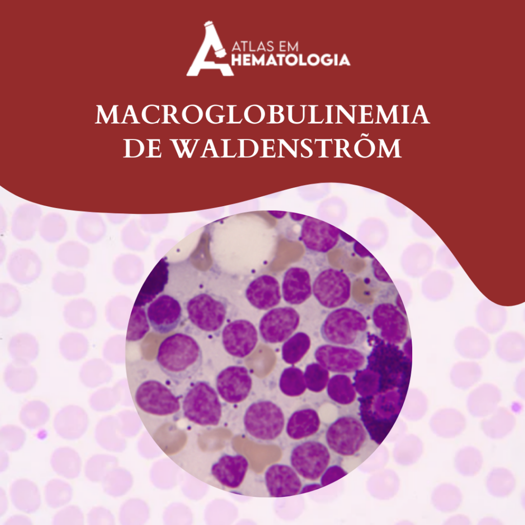 MACROGLOBULINEMIA DE WALDENSTRÕM