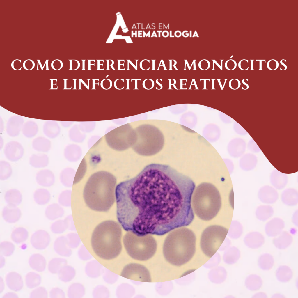 COMO DIFERENCIAR MONÓCITOS DE LINFÓCITOS REATIVOS