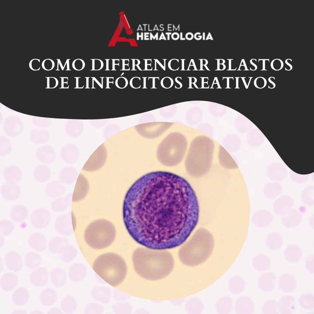 COMO DIFERENCIAR BLASTOS DE LINFÓCITOS REATIVOS
