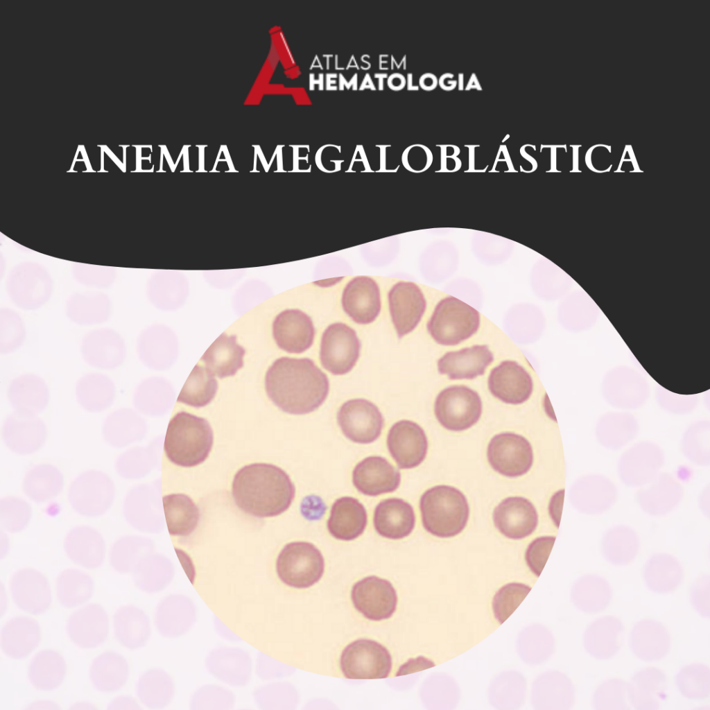 ANEMIA MEGALOBLÁSTICA