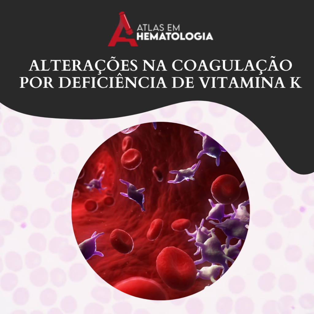 ALTERAÇÕES NA COAGULAÇÃO POR DEFICIÊNCIA DE VITAMINA K