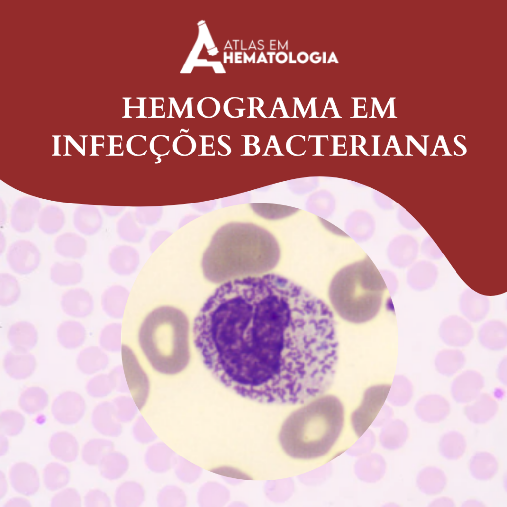 HEMOGRAMA EM INFECÇÕES BACTERIANAS