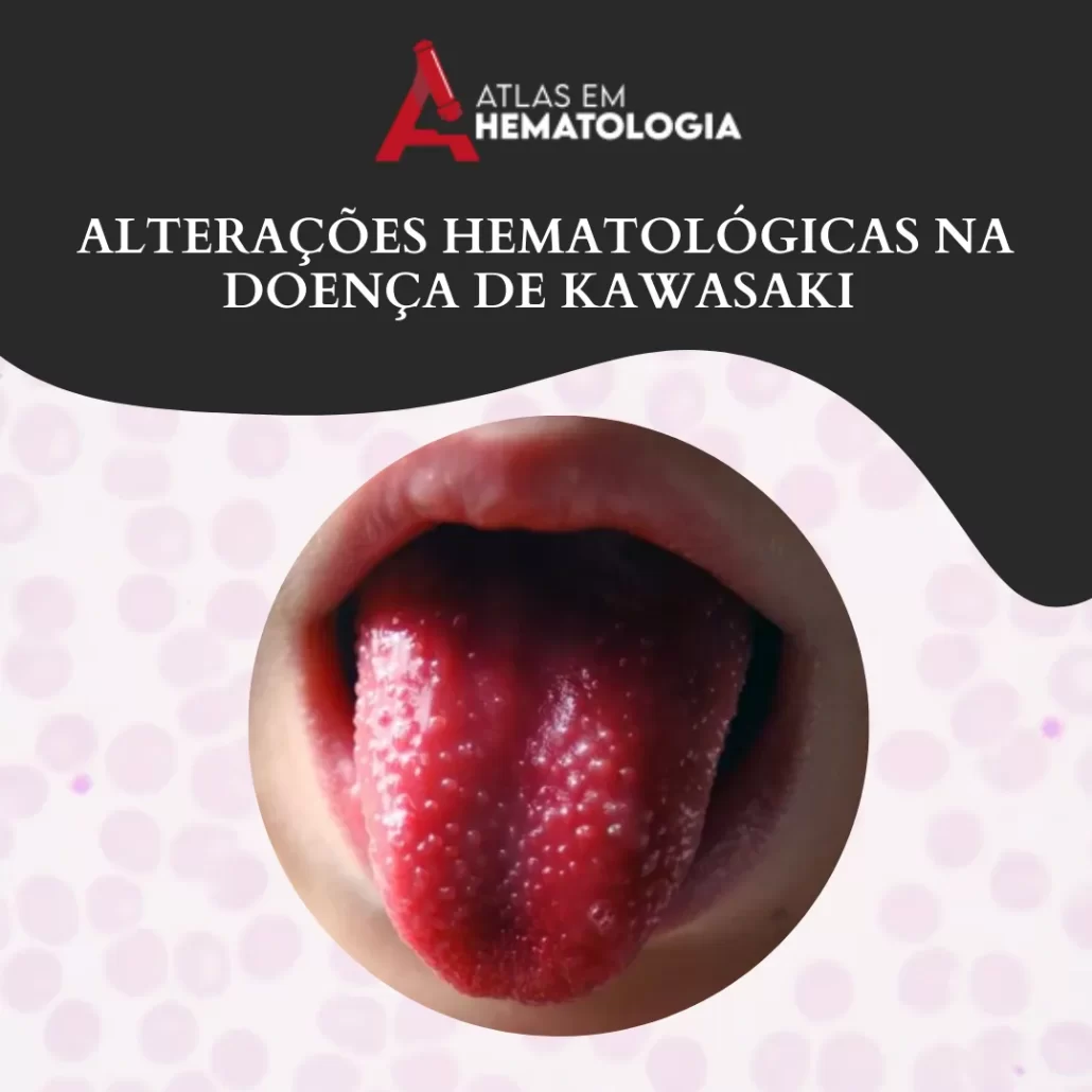 ALTERAÇÕES HEMATOLÓGICAS NA DOENÇA DE KAWASAKI