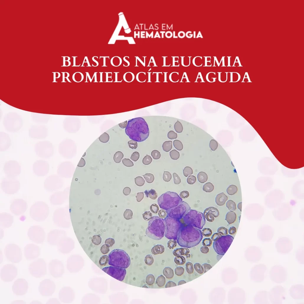 Blastos na Leucemia Promielocítica Aguda