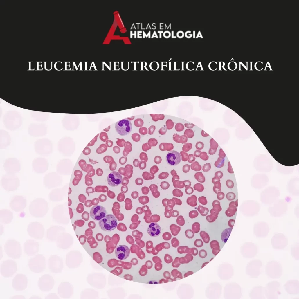 LEUCEMIA NEUTROFÍLICA CRÔNICA