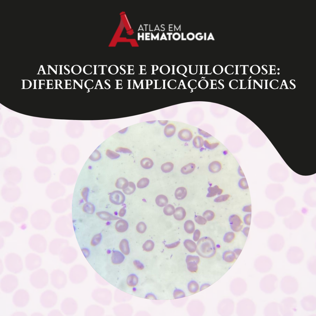 Anisocitose e Poiquilocitose: Diferenças e Implicações Clínicas