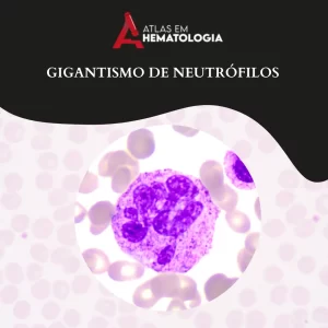 Gigantismo de Neutrófilos