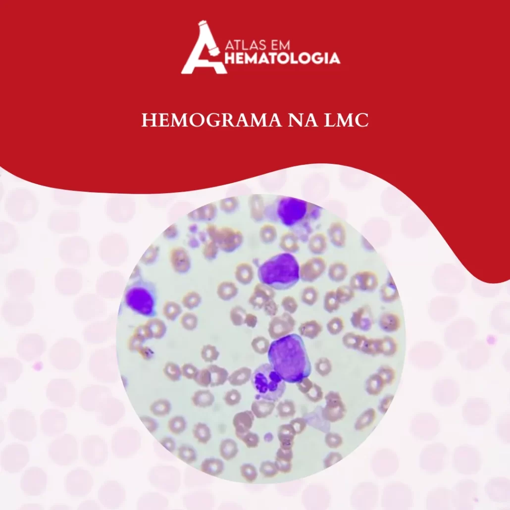 Hemograma na LMC