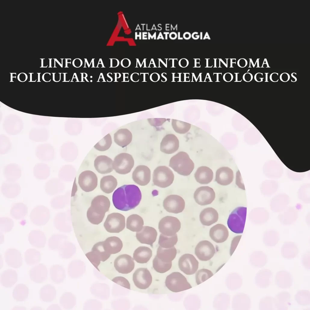Linfoma do Manto e Linfoma Folicular: Aspectos Hematológicos