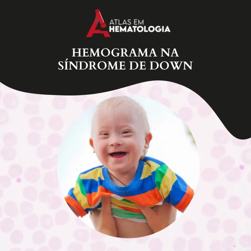 Hemograma na Síndrome de Down