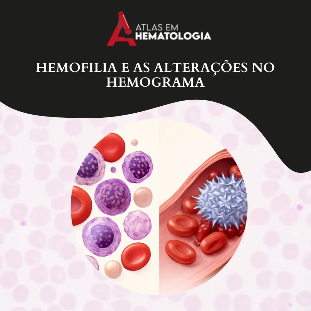 Hemofilia e as Alterações no Hemograma
